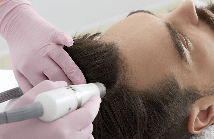 Capilar Microneedling
