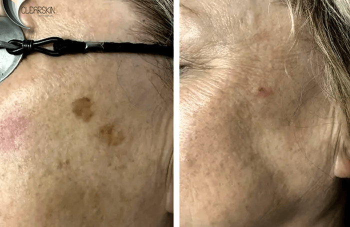 Eliminación de manchas cutáneas