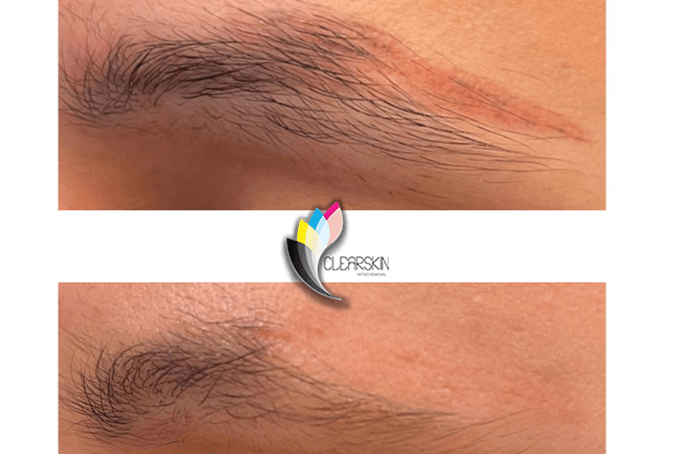 Eliminación de maquillaje permanente