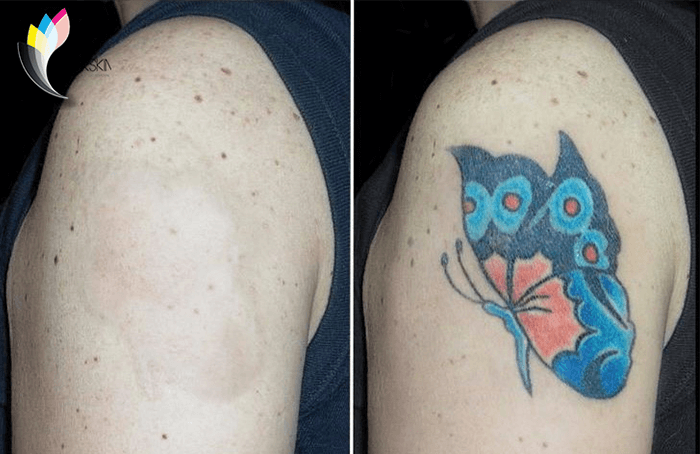 Remoción de tatuajes